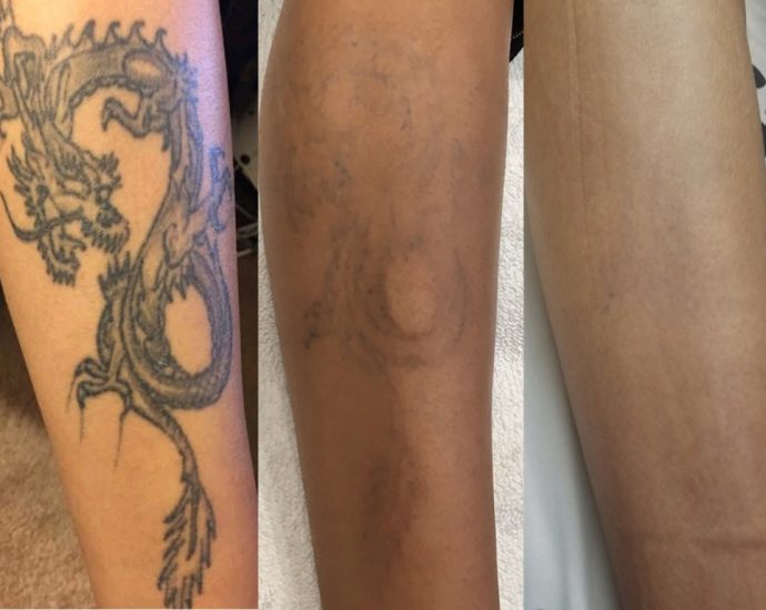 Tattoo Bubbling: Causes, Appearance, and What to Do